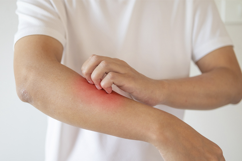 Symptômes de piqûre de punaises de lit sur le bras d'un homme