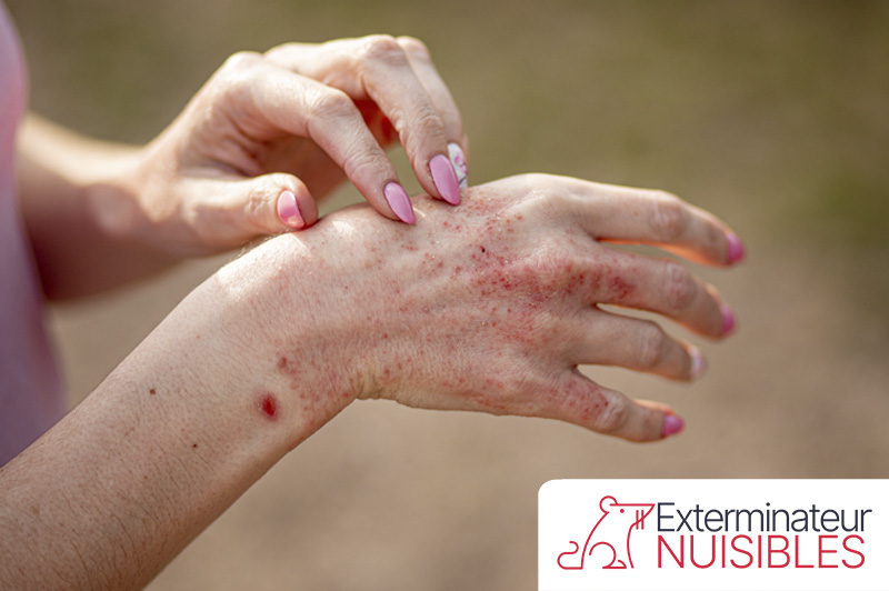 Symptômes de piqûre de punaises de lit sur la main
