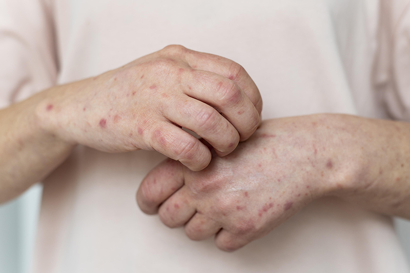 Piqûre de punaises de lit sur les mains