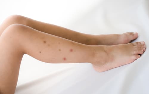 piqures de punaises de lit sur les jambes